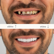 SMILEFIT PRO – SET ADAPTABIL DE DINȚI PENTRU UN ZÂMBET PERFECT