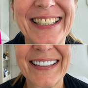 SMILEFIT PRO – SET ADAPTABIL DE DINȚI PENTRU UN ZÂMBET PERFECT